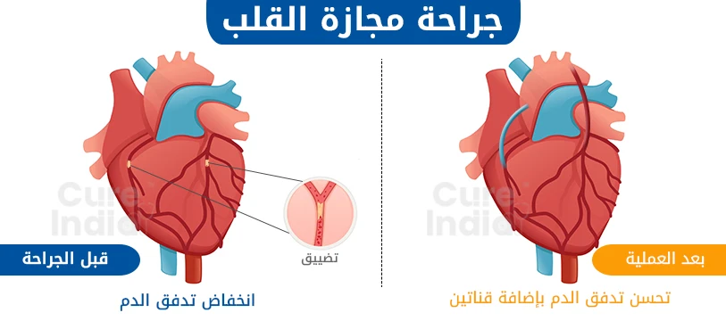 عملية تبديل شرايين القلب في الهند